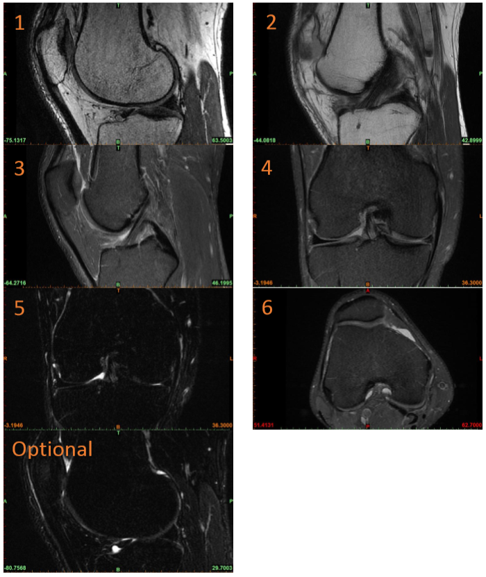 MR Osteochondral Planning Knee WO Protocol OHSU